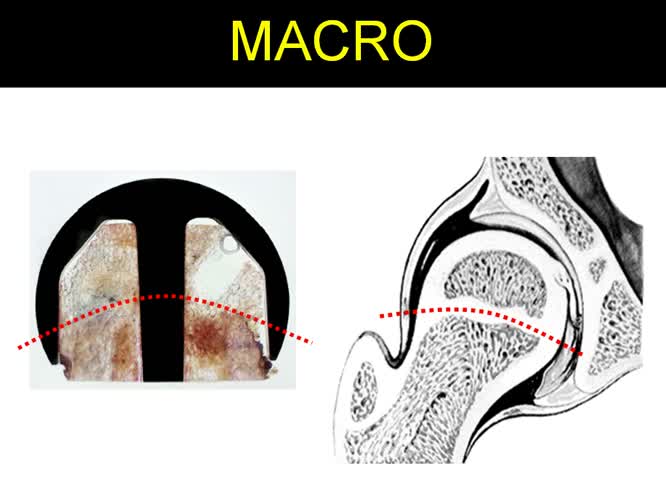 La protesi emicefalica indicazioni e risultati preliminari