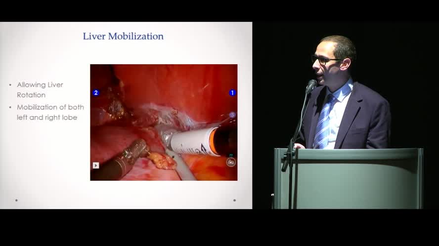 Minimally invasive approach to posterior segments in liver surgery