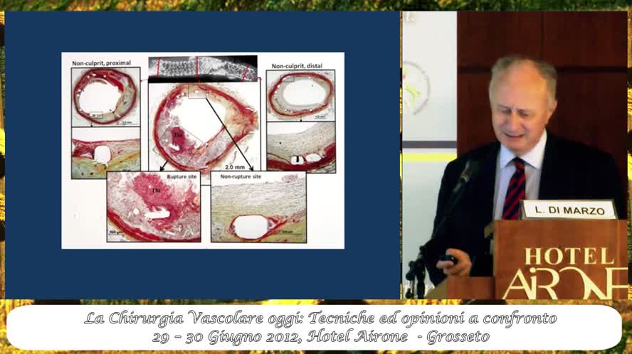 Lo studio ecocolordoppler nella diagnosi di stenosi o kinking delle "gambette" dopo EVAR: prevenzione delle complicanze