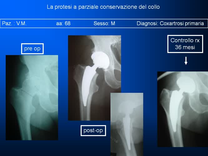 La protesi a parziale conservazione del collo