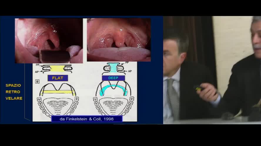 Tavola rotonda: "Chirurgia palatale in OSAS: esperienze a confronto su diagnostica e terapia"