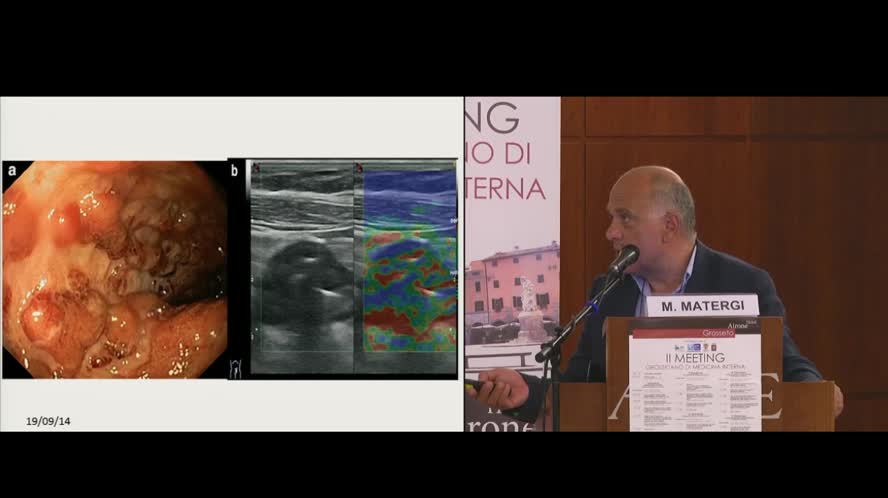 La fase attiva della colite ulcerosa: attualità nella diagnosi e nella terapia