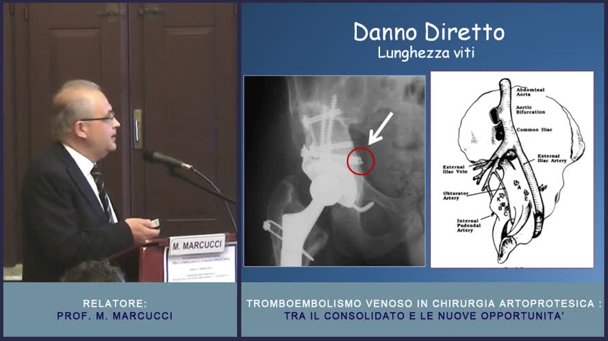 Il problema del TEV in ortopedia protesica
