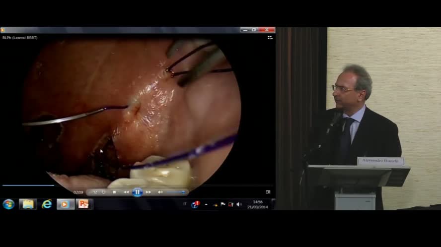 Barber Lateral Pharyngoplasty - BLPh