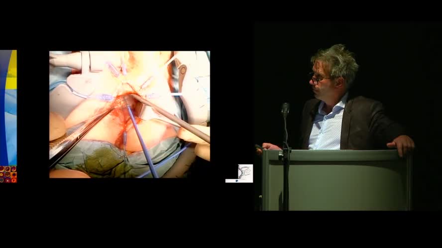 Transanal TME: it is really the best way?