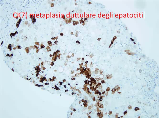 La biopsia epatica oggi: il parere dell'anatomopatologo