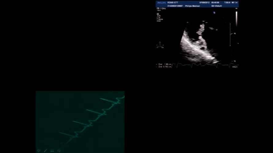 Diagnosi ecografica di endocardite