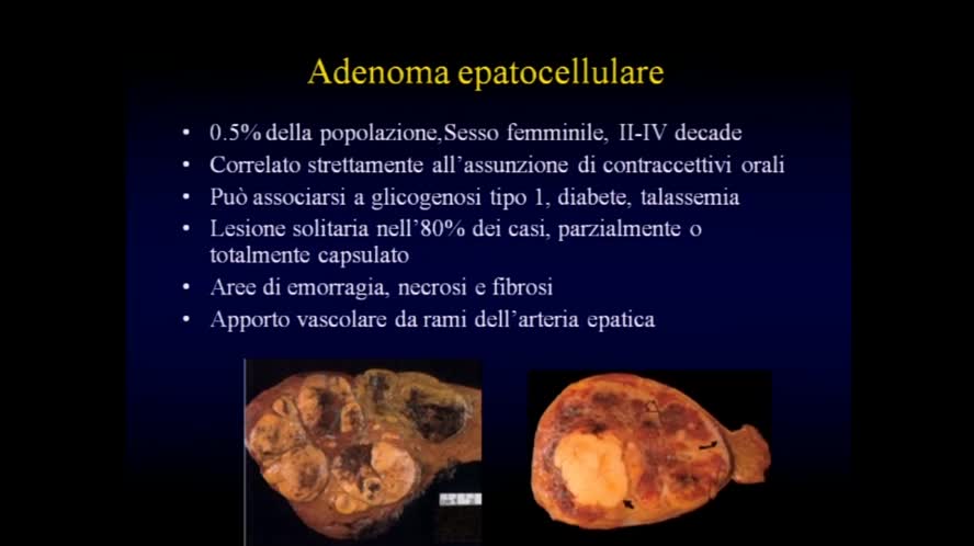 Inquadramento clinico-ecografico delle lesioni focali epatiche