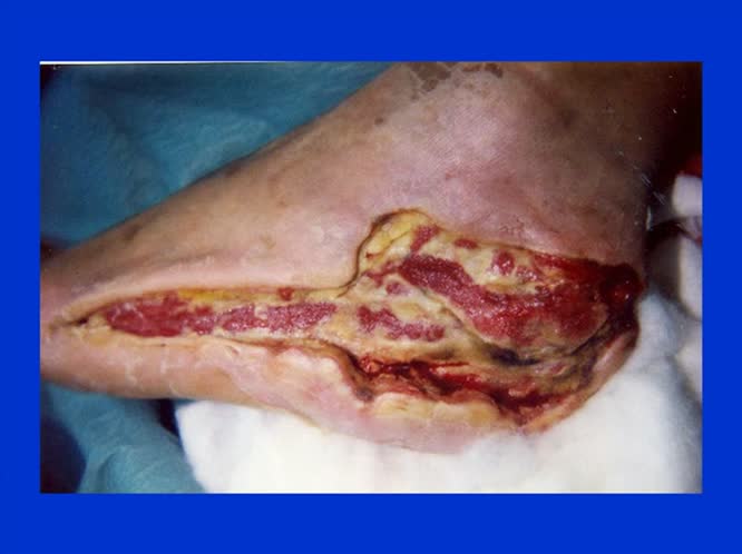 La terapia antimicrobica del PDI