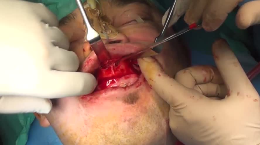 Avanzamento bimascellare