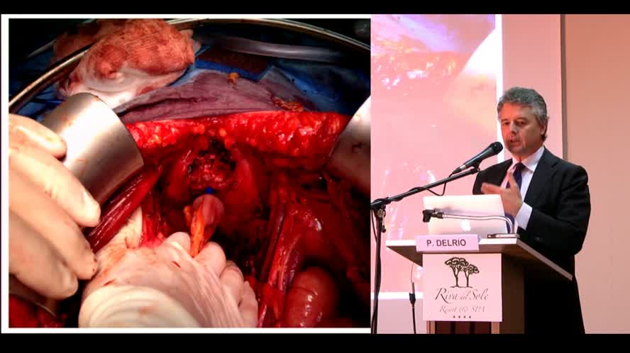 Surgical treatment of pelvic recurrence