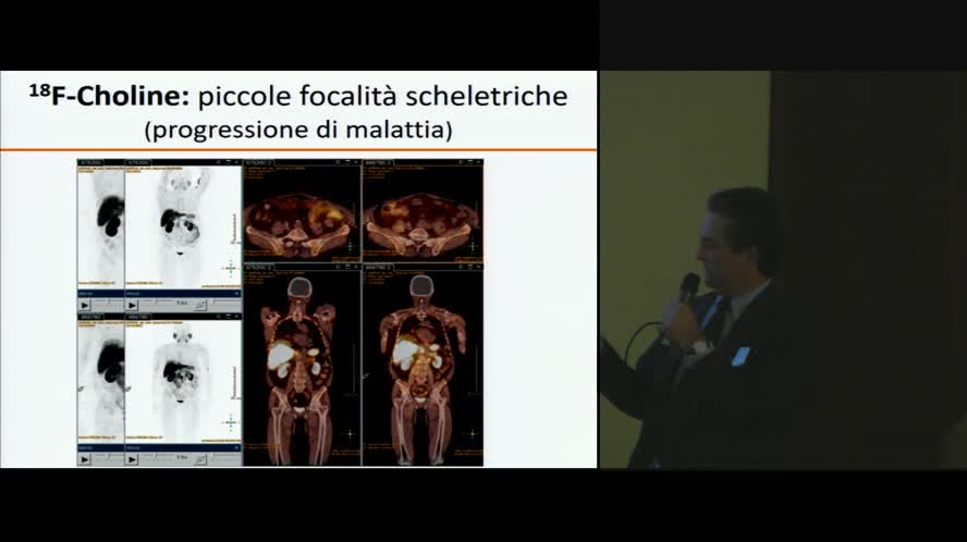 La PET/TC: dalla fluoro-colina alla PET-PSMA