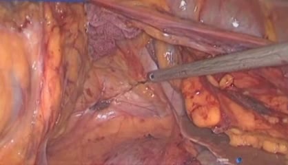 3 Marzo 2014 - Laparoscopic Total Colectomy, Laparoscopic Right Hemicolectomy, Laparoscopic Low Anterior Resection, Laparoscopic Left Hemicolectomy