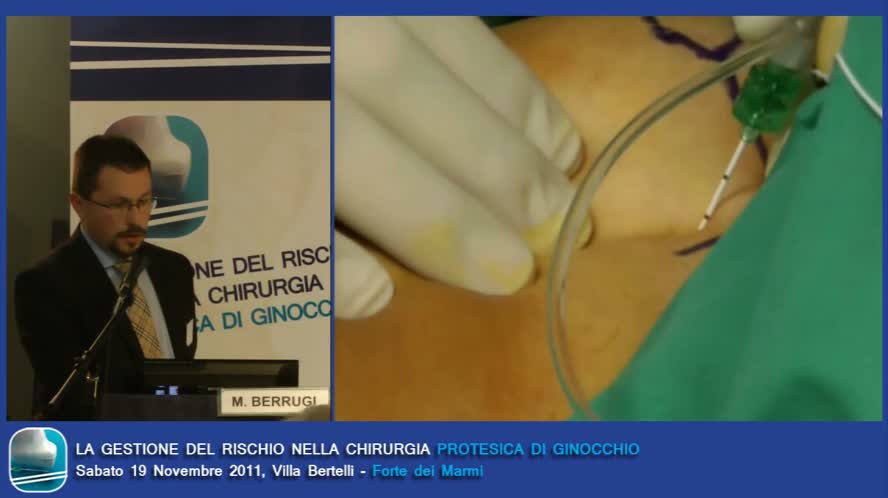 Blocchi periferici continui, quali, come e dove