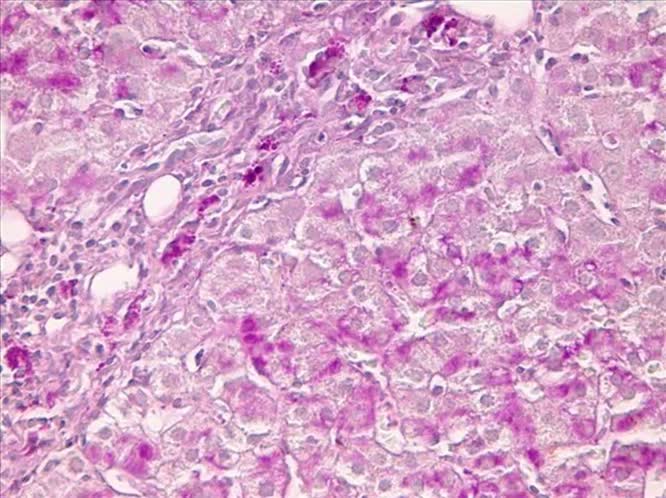 Epatite acuta da cimicifuga racemosa Descrizione di un caso clinico