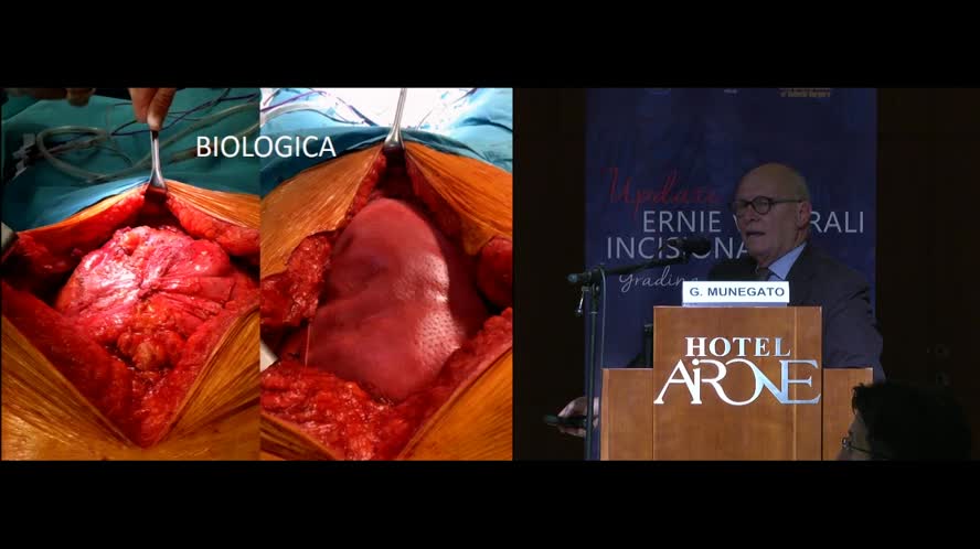 Rinforzo con sintetico non riassorbibile/riassorbibile nella separazione dei componenti posteriore