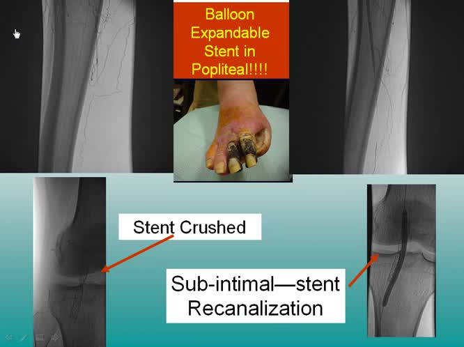 Rivascolarizzazione percutanea dell'aterosclerosi degli arti inferiori quando intervenire con quali risultati
