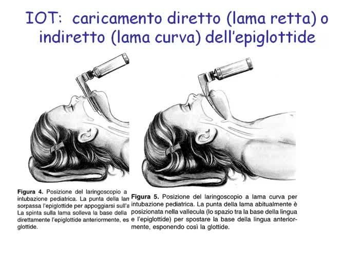 Gestione delle vie aeree nel paziente pediatrico