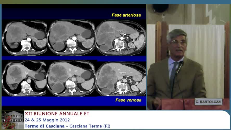 Linfoma primitivo epatico