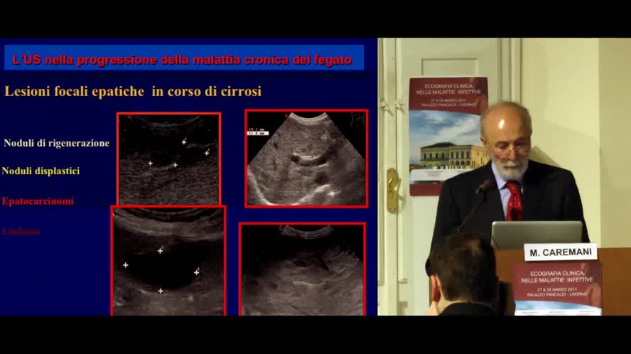 Dall' epatite cronica alla cirrosi  